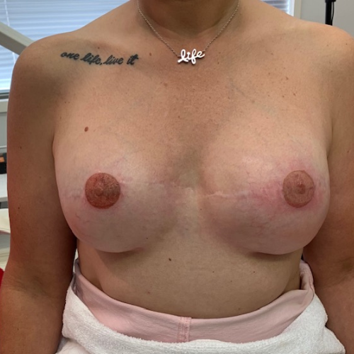 Areola cosmetic tattooing