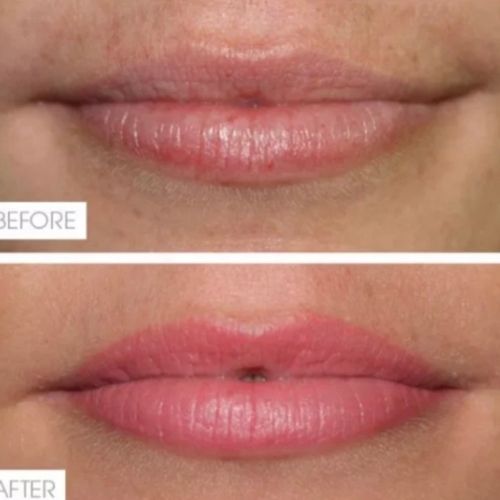 Cosmetic lip tattoo