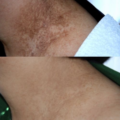 Herbal Activ_before_after_neck