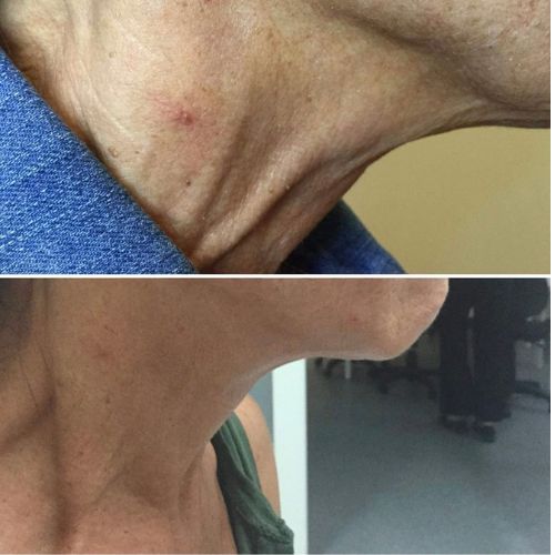 Plasma fibroblast neck lift